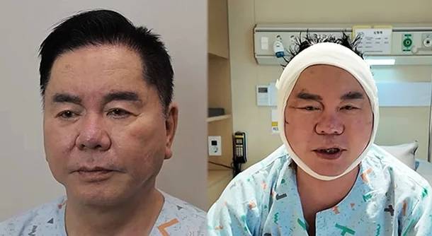 심형래 안면거상. 유튜브 캡처