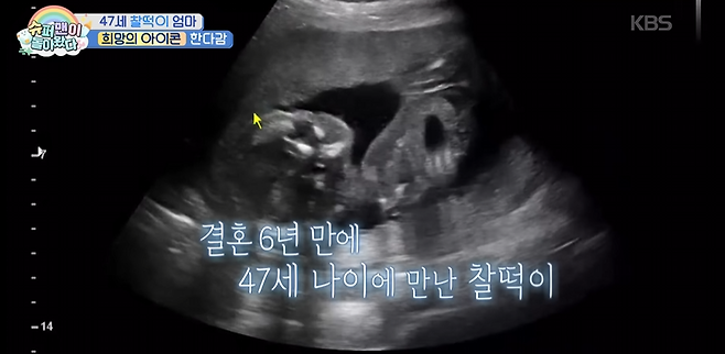 Actress Handagam has revealed the secret of her 47-year-old pregnancy with a healthy uterus.On the Wednesday broadcast of KBS2s Superman is Back, Handa, who is currently 20 weeks pregnant, appeared on the show and shared her daily life as a mom-to-be. On the show, Handa explained the meaning of her name, Chaktak, saying, Its a blessing that came to me at a late age, so I named it to stay healthy and attached.Ive been thinking about having a child since I was 44, said Handagam, who became pregnant after six years of marriage. After preparing for about two or three years, I started trying in earnest in the winter of 46, and I got the good news at 47.Hagams story is particularly noteworthy because he revealed that he was told something unexpected at the hospital. The doctor said, If your uterus is in this condition, you can have a second or third, he said.She also revealed that she froze her eggs. I froze my eggs when I was in my 30s, but when I went to the hospital at 46, they told me that I didnt need to use my old eggs, she said. I got pregnant with my most recent eggs. The eggs I froze in the past are being kept as insurance, she explained.Lalal was impressed, saying, Its really not that easy, and Kim Jong-min was also surprised, saying, There must be some special know-how.Meanwhile, Handa got married to a non-celebrity businessman in 2020. The 47-year-old recently made headlines when she announced her pregnancy and is due to give birth in September.