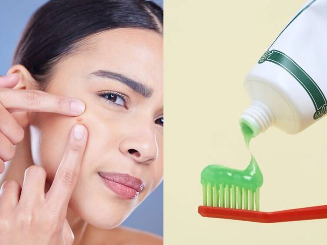 치약에는 불소, 계면활성제, 향료 등 다양한 성분이 들어 있는데, 이런 성분들은 치아를 깨끗하게 관리하는 데는 도움이 되지만 피부에는 자극이 될 수 있습니다. 사진=게티이미지뱅크