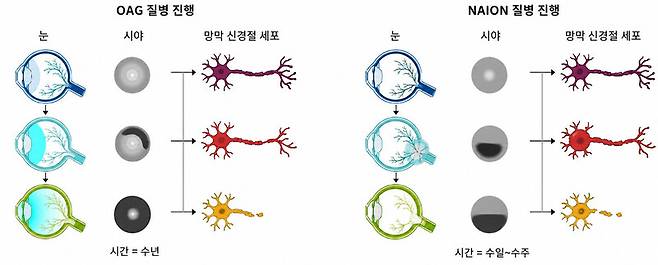 개방각 녹내장(OAG, 왼쪽)과 비동맥성 전방 허혈성 시신경병증(NAION, 오른쪽)의 질병 진행 과정을 묘사한 그림. 출처=라이프 바이오사언스