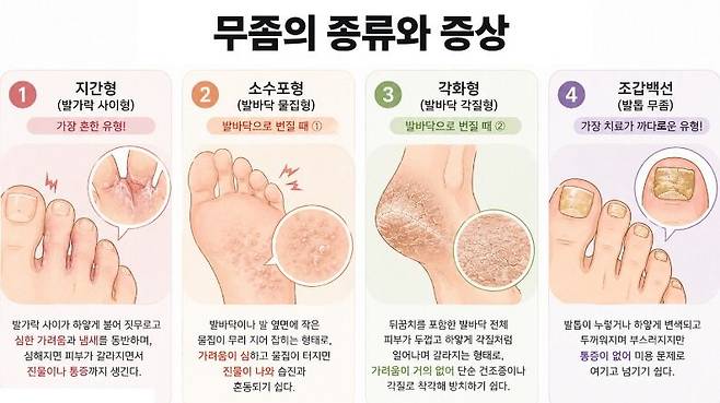 무좀의 종류와 증상. /사진=챗GPT