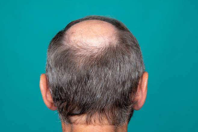 테스토스테론에 수소 원자 2개가 붙은 DHT(Dihydrotestosterone) 분자는 머리카락이 빠지게 하고 전립선도 붓게 한다. GETTYIMAGES