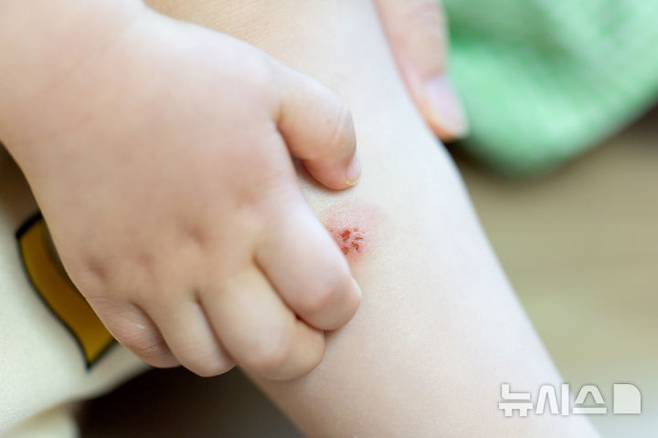 [서울=뉴시스] 여름철 벌레에 물린 후 상처가 생기면 연조작염으로 이어질 수 있어 주의가 필요하다. (사진= 유토이미지 제공)