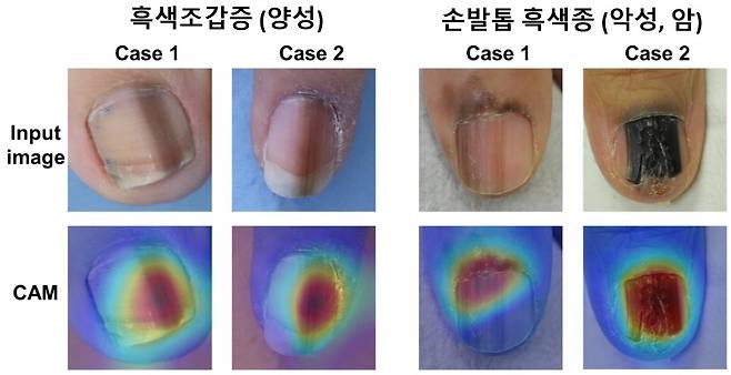 (서울=연합뉴스) 흑색조갑증(양성)에 비해 손발톱 흑색종(악성, 암)은 빠르게 넓어지거나 진해지는 경우가 많으며, 손톱 주변의 피부까지 퍼지는 양상을 보인다. 흑색종은 불규칙하고 다양한 색상을 나타내며, 손발톱이 갈라지거나 부서지는 경향이 동반되기도 한다. AI가 두 가지를 구분하는 데에 중요한 부분을 활성화(Class Activation Map, CAM)해 보여주고 있다. 2026.08.11. [세브란스병원 제공. 재판매 및 DB 금지]