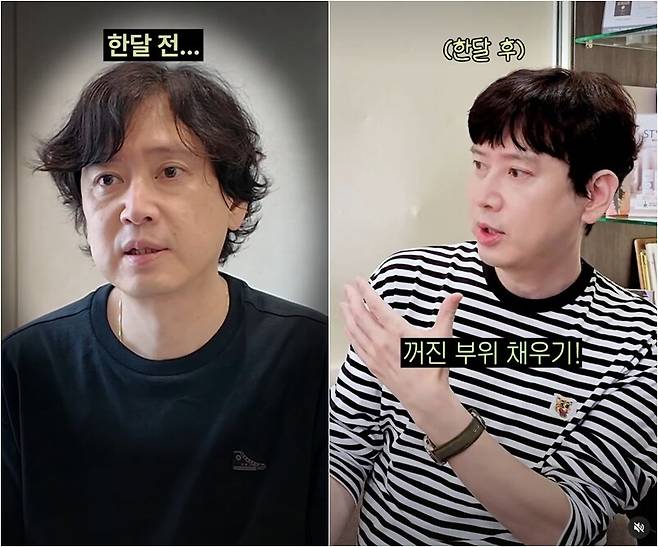 ▲ 배우 김진의 시술 비포-애프터 모습. 출처ㅣcircleclinic_official 계정