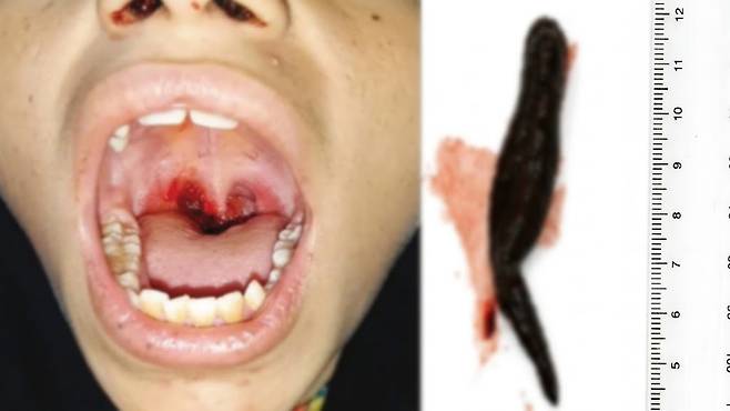 계곡물을 마신 뒤 일주일 동안 반복해서 코피가 나고 음식을 삼키기 어려워했던 12세 아이의 목에서 살아 있는 거머리가 발견됐다. 사진=임상사례보고(Clinical Case Reports)
