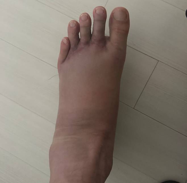 육상 높이뛰기 우상혁은 왼쪽 발 앞꿈치의 탄력을 활용해 도약해서 왼발이 심하게 변형됐다. 지난 5월 리스프랑 인대 파열 직후에는 사진처럼 발등이 퉁퉁 붓기도 했다. 우상혁 선수가 한겨레에 제공한 사진이다.