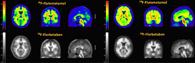 Comparison of PET-CT images using Vizamyl (top, color) and Neuraceq (bottom, black and white) for Alzheimer's disease diagnosis. (Source=DuChemBio)