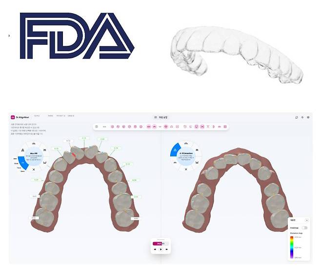 이노디테크, AI 교정 플래닝 SW '닥터얼라인네비' 미국 FDA 허가 획득 / 출처=이노디테크