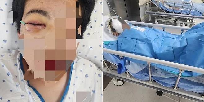 학교폭력 피해로 안와골절 등 심각한 부상을 입었던 학생이 가해자들과 같은 반이라 한 달 반째 학교에 가지 못 하는 등 극심한 고통을 호소하고 있다. 이 가운데 학교 교장이 "가해 학생들은 졸업할 때까지 잘 가르쳐서 보디가드로 쓰면 된다"고 두둔하는 발언을 한 것으로 알려져 논란이 되고 있다. /사진=보배드림