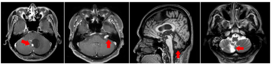좌측부터 소뇌종양, 전정신경초종, 다발신경계위축증(퇴행성 뇌질환), 뇌경색