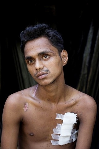 ▲18살 소년은 로힝야족이란 이유로 버마 군인들이 쏜 총에 맞았다. ⓒDan Kitwood