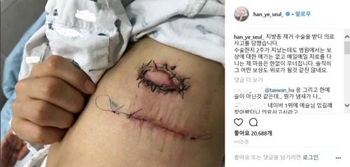 양성 종양은 몸에 큰 문제를 초래하지 않아 그대로 둬도 상관 없고, 불편한 경우 제거한다./사진=한예슬 인스타그램 캡처