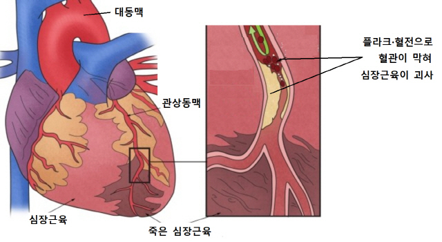 출처: 서울아산병원 심장병원