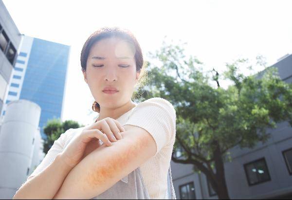 30~40도의 햇볕만으로도 화상을 입을 수 있다./조선일보 DB