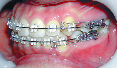치아교정..만 5세부터 '악정형' 치료 가능, 투명장치는 증세 심할때 부적합