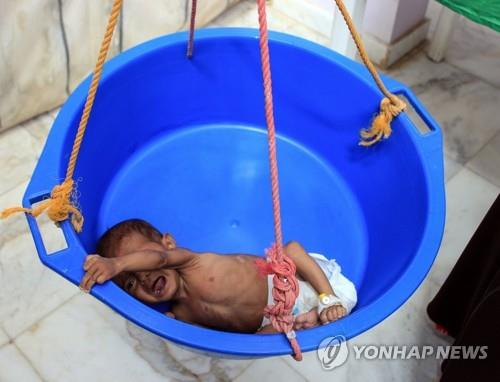 영양실조에 시달리고 있는 예멘의 한 어린이가 병원에서 몸무게를 재고 있다. [AFP=연합뉴스]
