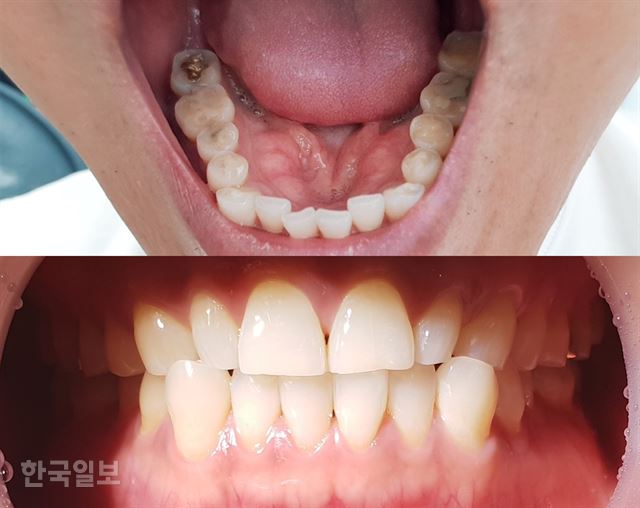[저작권 한국일보]마모가 심하게 된 40대 중반 남성의 치아 사진. 잘못된 치아관리와 생활습관으로 50대 중반에서 볼 수 있는 치아상태(위의 사진)를 보이고 있다. 아래 사진은 겉으로는 큰 이상이 없어 보이지만 잇몸 퇴축과 치주질환 전조 증상을 나타내고 있다. 김민규기자 whitekmg@hankookilbo.com