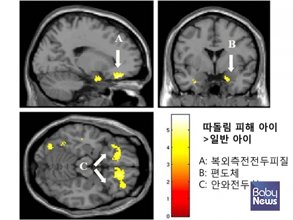 따돌림 피해를 받은 아이의 뇌. ⓒ김영훈