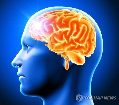뇌경색 [게티이미지뱅크 제공