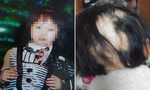 서혜림(가명)양의 여섯살 때(왼쪽 사진)와 최근 모습. 서동수씨 제공