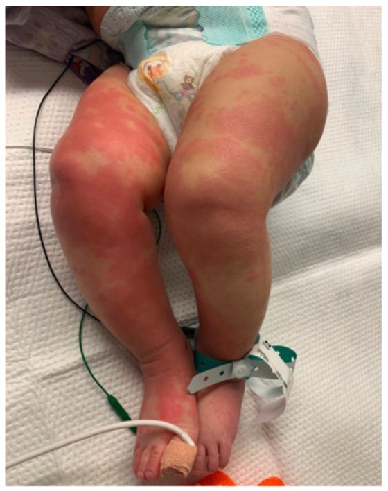 4월달 미국 소아과 학회가 발표한 가와사키 병을 앓고 있는 아이의 모습. 생후 6개월의 이 아이는 코로나19 양성 판정을 받았다. [미국 소아과 협회 제공]