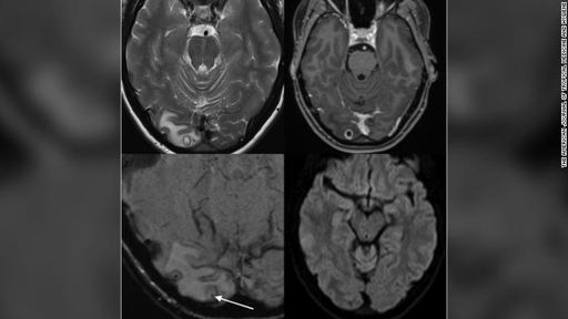 뇌에서 기생충이 발견된 A씨의 MRI 영상. AJTMH 제공