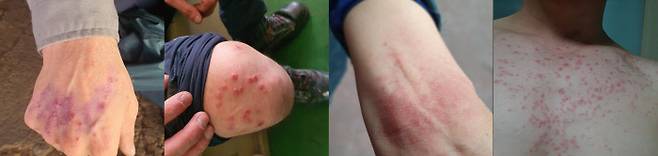 현대중공업 울산조선소 도장공장 작업자들에게는 지난해 5월부터 집단 피부병이 나타났다. 손과 팔에서 시작된 붉은 반점은 가슴과 복부, 다리까지 번졌다. 금속노조 현대중공업지부 제공