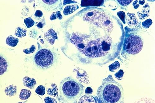 인간의 림프종 세포= 림프종에 화학 치료제를 쓰면 암세포의 염색체가 비정상으로 늘어나고 세포 자체도 커지는 경우가 많다.[미 국립 암연구소 제공 / 재판매 및 DB 금지]