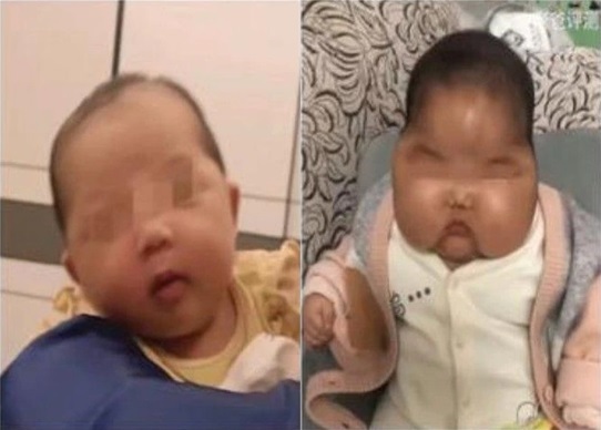 스테로이드 호르몬이 포함된 크림을 바른 아이의 전후 사진. 바른 후의 얼굴(오른쪽)이 훨씬 부어있다./사진=트위터