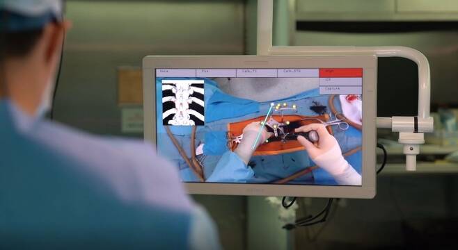 ▲환자 수술 부위에 투영된 AR 기반 오버레이 그래픽으로 나사못이 들어갈 위치를 파악하고 있는 모습. 분당서울대병원 제공 