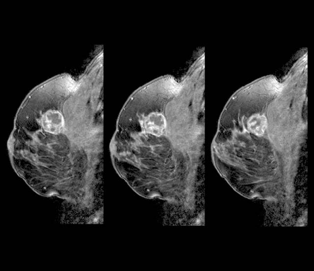 치밀유방을 가진 경우에는 유방X선 검사와 함께 초음파도 병행하는 것이 바람직하다./클립아트코리아 제공