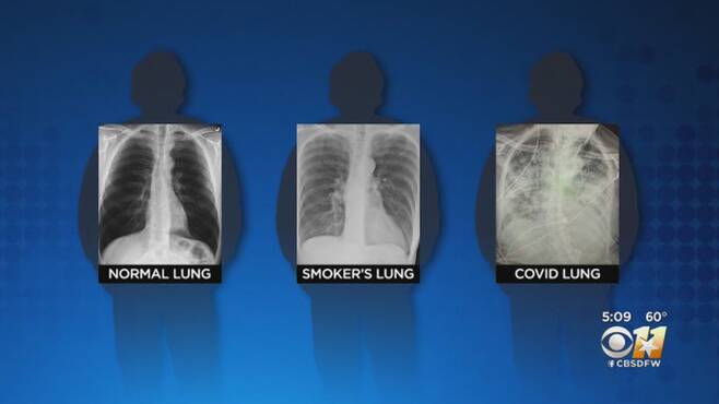 건강한 사람과 흡연자 그리고 코로나19 환자의 폐 비교(사진=CBS DFW)