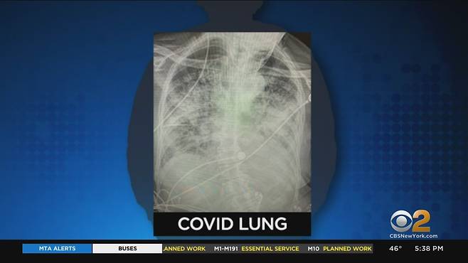 코로나19 환자의 폐 모습(사진=CBS DFW)