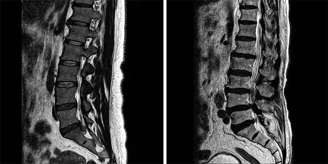 추간판탈출증<왼쪽> 환자와 척추관협착증<오른쪽> 환자의 측면 MRI 사진. /서울바른병원 제공