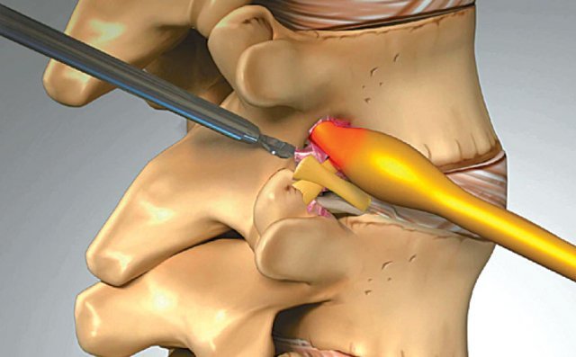 한미일 특허받은 키트를 ‘추간공접근법’을 통해 추간공으로 삽입하여 인대를 절제하는 방식으로 추간공확장술을 진행하는 모습.