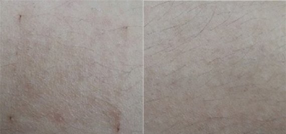 KAIST 조영호 교수팀이 7일간 피부에 부착하는 실험을 진행한 결과, 기존 폴리머 층(왼쪽)은 피부 홍조가 2.7로 발진이 생겼으나 새로 개발한 다공성 폴리머 층은 피부홍조가 1.1로 피부 발진이 발생하지 않았다. KAIST 제공