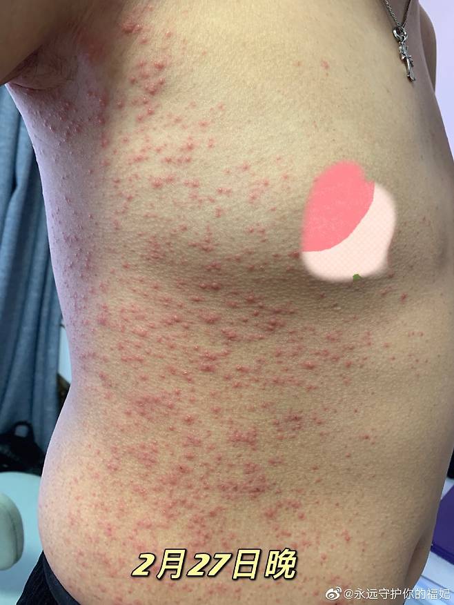 지난 1일 중국 SNS에 올라온 시노팜 백신 접종자의 온몸에 퍼진 붉은 반점 사진. [웨이보 캡처]