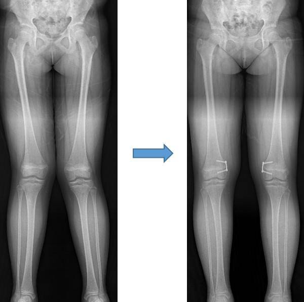 반성장판 유합술로 외반슬(X다리)을 교정한 11세 여아의 수술 전후 엑스레이 영상
