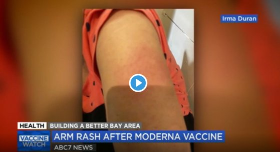 모더나 백신을 맞고 난 뒤 일부 접종자에게서 '붉은 팔'현상이 나타났다. [ABC7 뉴스 캡처]