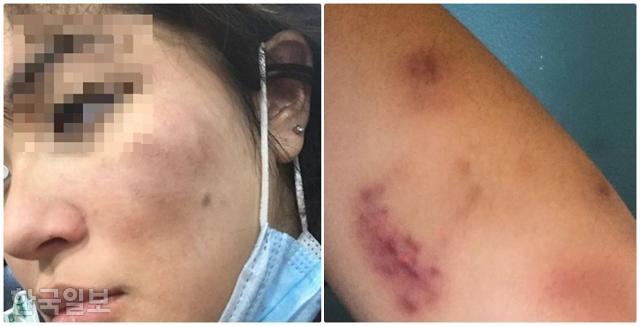 미국 캘리포니아주 터스틴의 한 공원에서 인종차별적 폭언과 폭행을 당한 한국계 여성 제나 두푸이. 얼굴(왼쪽 사진)과 팔에 멍이 들었다. 인스타그램 캡처
