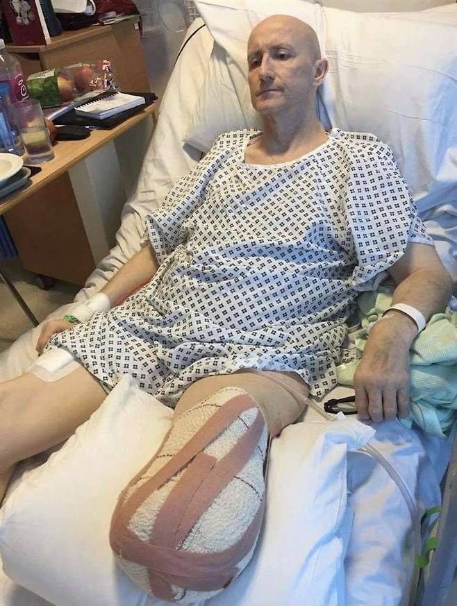 아스트라제네카의 코로나 바이러스 백신 접종 이후 왼쪽 다리를 절단한 데이브 미어스. /스탬퍼드 머큐리