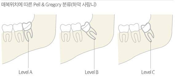 매복위치에 따른 사랑니 분류, 맹출된 위치에 따라 치료 난이도가 달라진다.(출처 : 강동경희대학교병원 원보 For You 1+2월호)