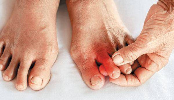 '바람만 스쳐도 아프다'는 통풍의 3대 위험 요소로는 남성, 기저질환, 엄지발가락 통증이 꼽힌다. 게티이미지뱅크