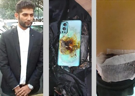 노드2 폭발 사고를 당했다고 주장하는 인도 변호사 굴라티.(왼쪽) 가운데는 옷 속에서 불타고 폭발한 중국 스마트폰 노드2.(가운데) 상처 위에 거즈를 댄 모습.(오른쪽) 인터넷 캡처