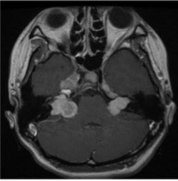 양측 청신경종양을 가진 2형 신경섬유종의 대표 뇌 MRI(자기공명영상).