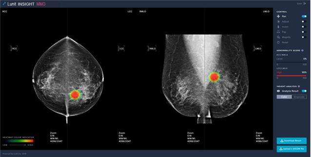[세종=뉴시스] 유방암 의심 부위를 자동으로 검출하는 인공지능 기반의 '유방암영상검출·진단보조소프트웨어'. (사진=식약처 제공) *재판매 및 DB 금지