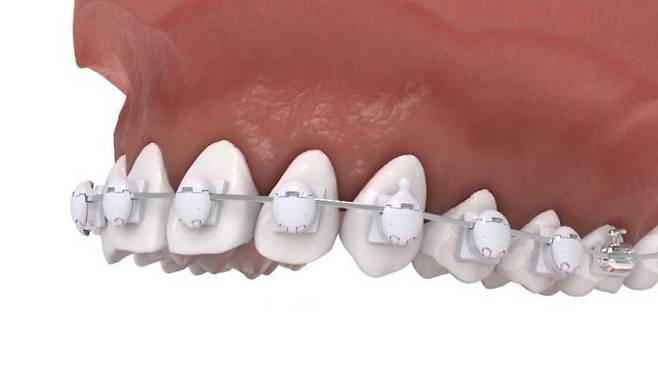 국내 원천기술로 개발되어 특허를 받은 ‘펄레이스’ 치아 교정장치를 부착한 모습. 메디센 제공