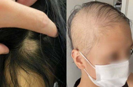 모더나 1차 접종 후 탈모증상이 시작되었다고 주장하고 있는 일본의 20대 여성. /사진=해당 여성 블로그 캡처