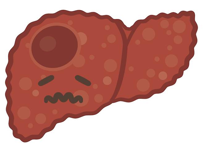 간암은 조기에 발견하고 치료하는 것이 생존율을 높이는 지름길이다. 게티이미지뱅크